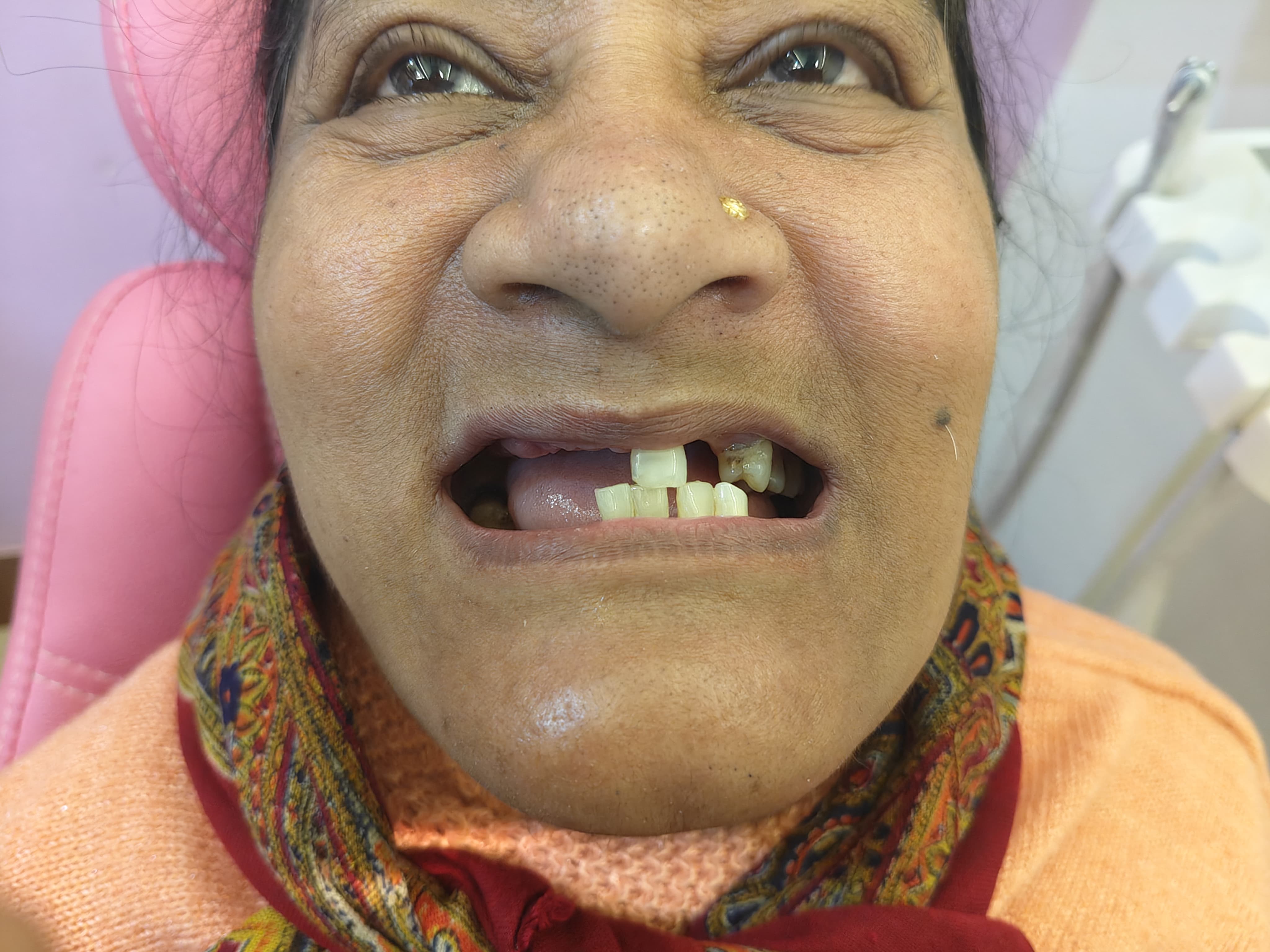 Smile Transformation Case 5